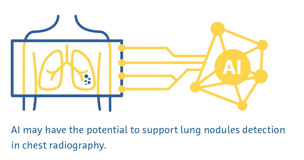 Lung nodule detection Lung nodule detection